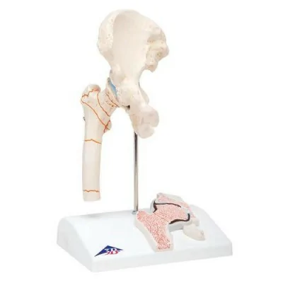 Fracture du fémur et usure de l'articulation de la hanche - Anatomie et pathologie