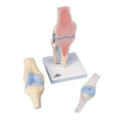 Modèle de coupe de l'articulation du genou, en 3 parties - Anatomie et pathologie