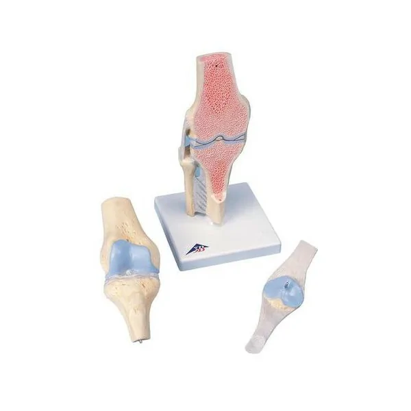 Modèle de coupe de l'articulation du genou, en 3 parties - Anatomie et pathologie