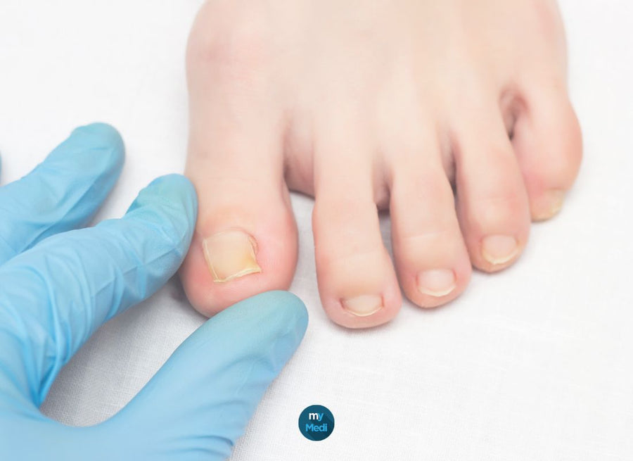Ongles incarnés : que faire pour les prévenir ? les traiter ?