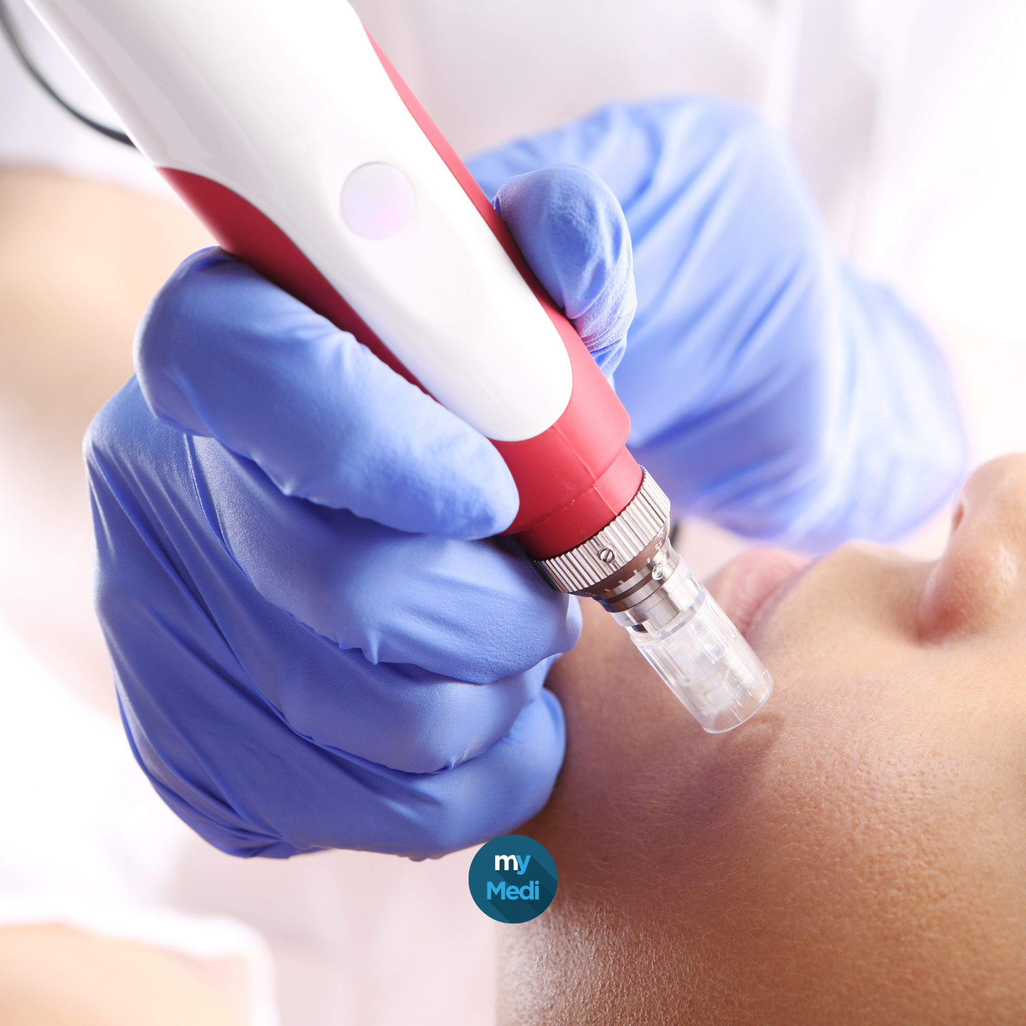 Trocart / Aiguilles de transfert