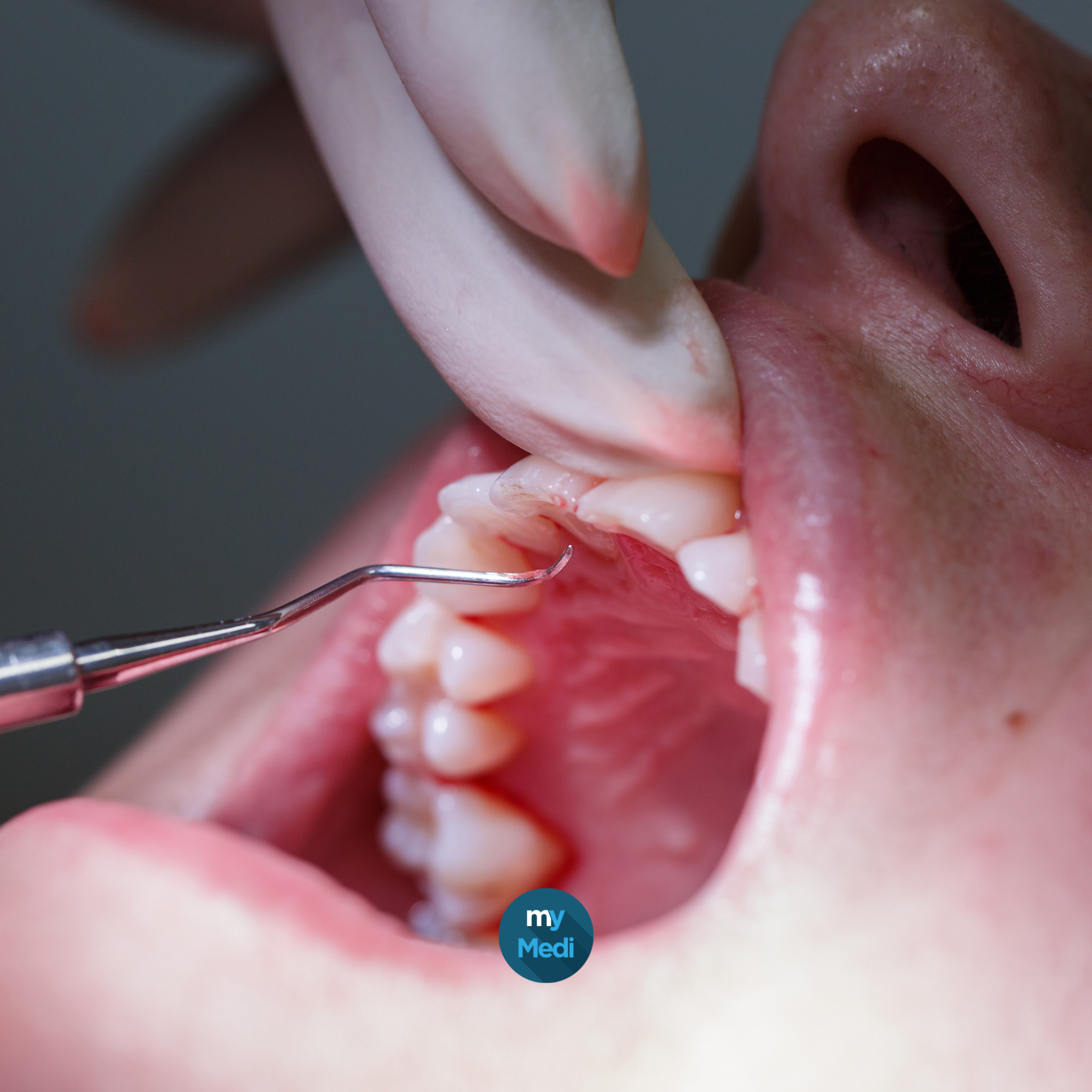 Curettes et instruments parodontologiques