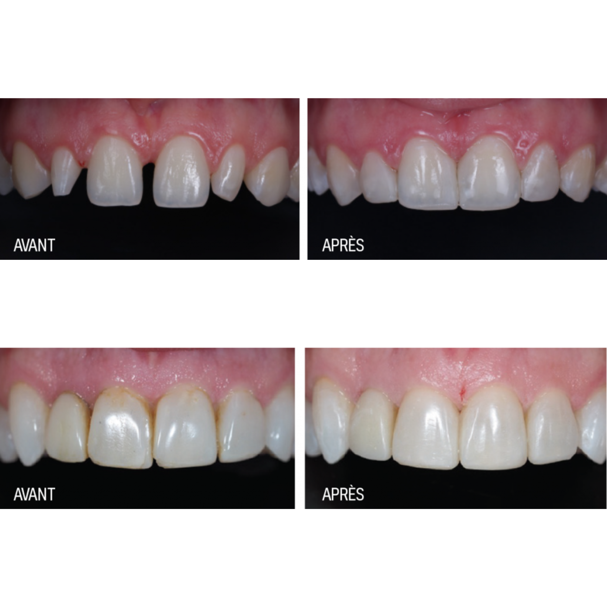 Luna 2 - composite universel - 4 g - SDI