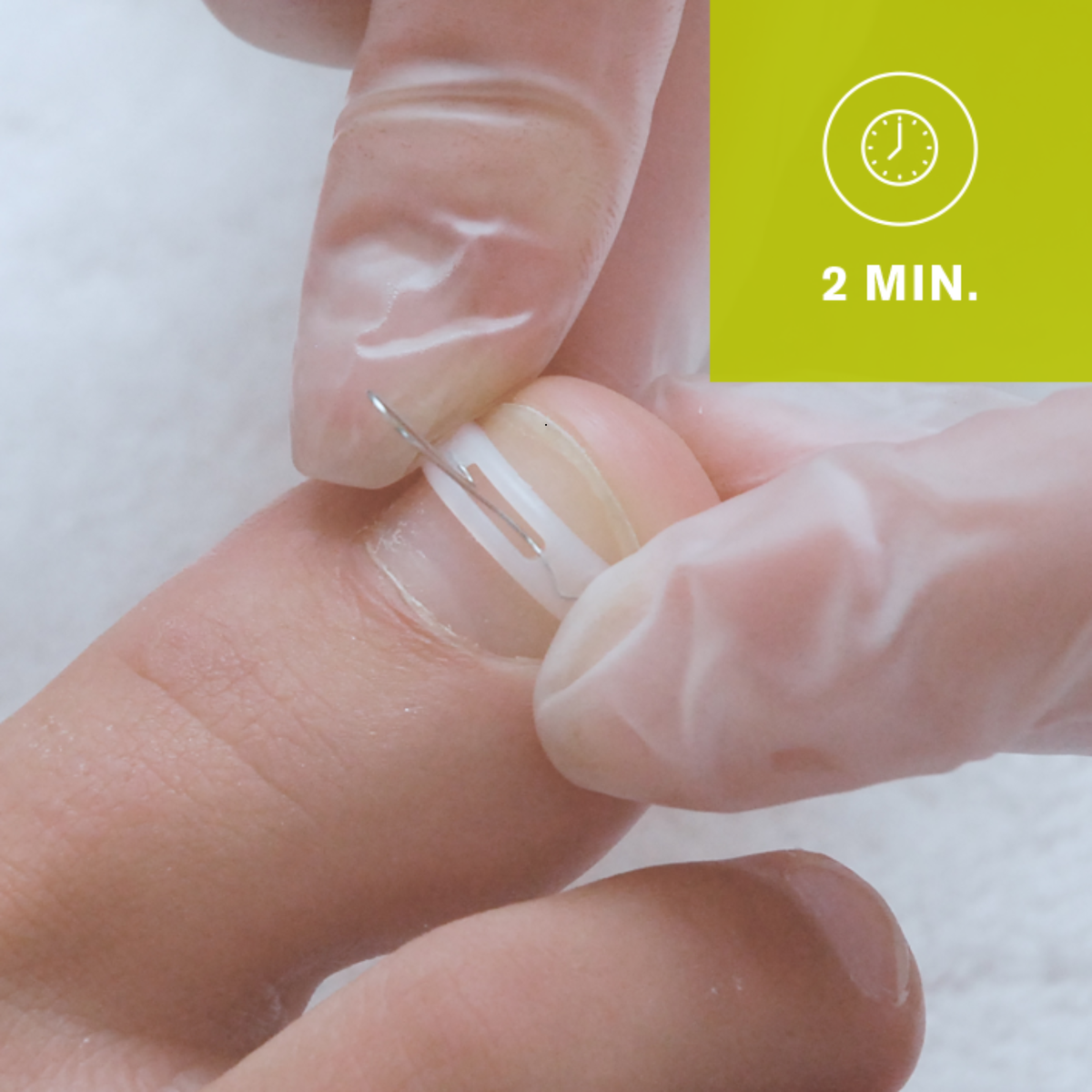 Languettes d’orthonyxie pour ongles incarnés et déformés - Différentes tailles - Podofix - My Médical