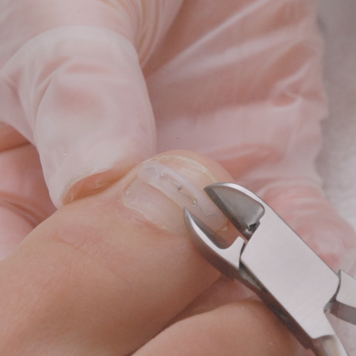 Languettes d’orthonyxie pour ongles incarnés et déformés - Différentes tailles - Podofix - My Médical